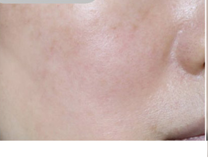 Customer-submitted before photograph associated with DIA Toning Serum