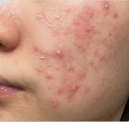 Customer-submitted before photograph associated with Setup Cream [CICA RS]